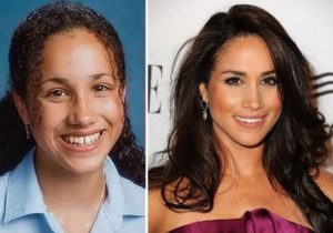 Meghan Markle Before and After Plastic Surgery