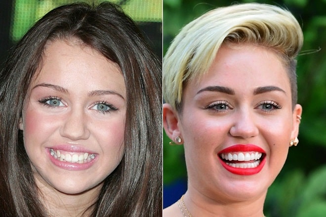 Miley Cyrus Before and After Plastic Surgery: Face, Nose, Teeth, Breast