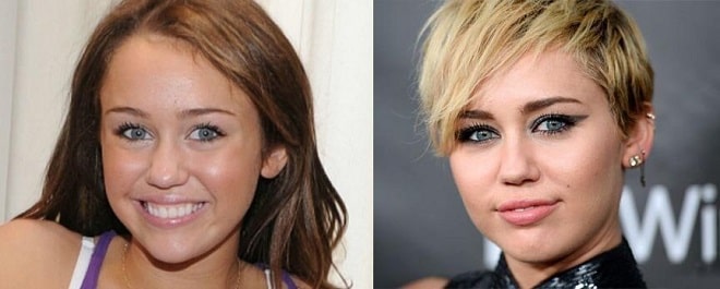 Miley Cyrus Before and After Plastic Surgery: Face, Nose, Teeth, Breast