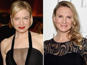 Renee Zellweger Before and After Plastic Surgery: facelift, botox