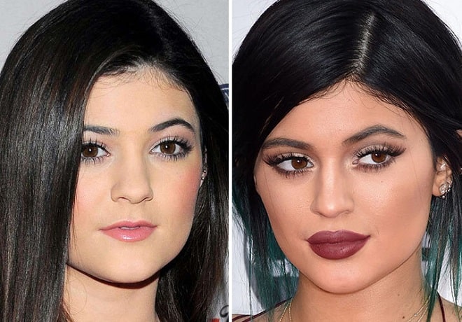 Kylie Jenner Before And After Plastic Surgery Lips Face Body