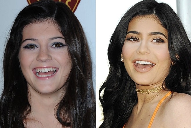 Kylie Jenner Before Kylie Jenner Before And After Nose Job Lip Injections Breast Kylie 