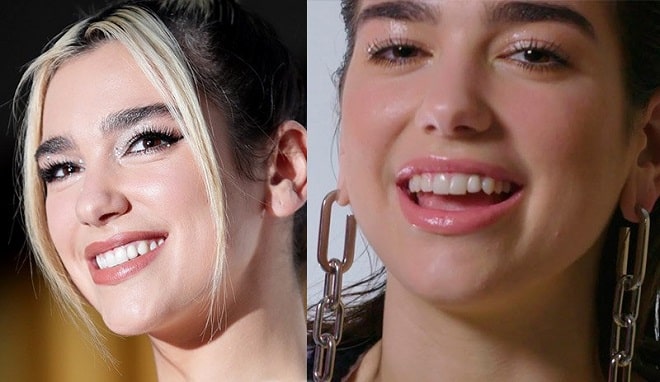 Dua Lipa Before And After Plastic Surgery Nose Lips Face 