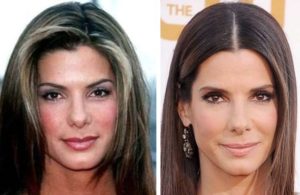 Sandra Bullock Before and After Plastic Surgery: Nose, Lips, Face