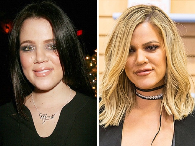 Khloe Kardashian Before and After Plastic Surgery