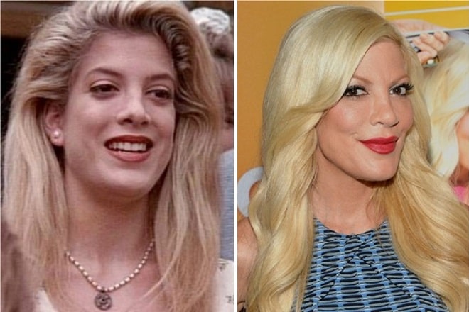 Tori Spelling Before And After Plastic Surgery 