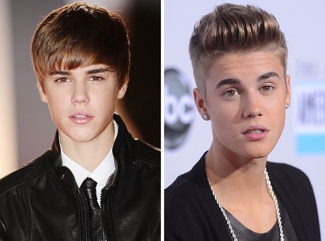 Justin Bieber Before and After Plastic Surgery