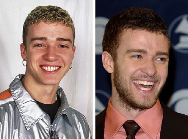 Justin Timberlake Before and After Plastic Surgery