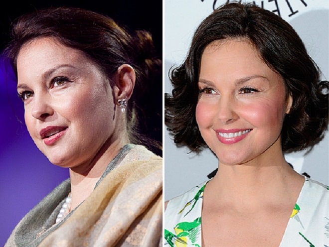 Ashley Judd Before and After Plastic Surgery