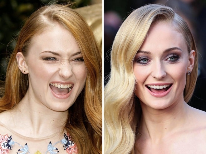 Sophie Turner Before And After Plastic Surgery