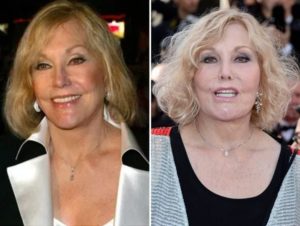 Kim Novak Before and After Plastic Surgery