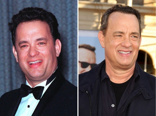 Tom Hanks Before and After Plastic Surgery: Face, Hair, Teeth