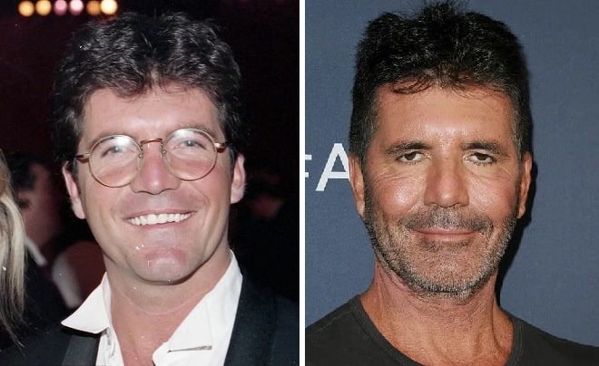 Simon Cowell Before And After Plastic Surgery: Facelift, Botox