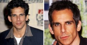 Ben Stiller Before and After Plastic Surgery: Ears, Nose, Face