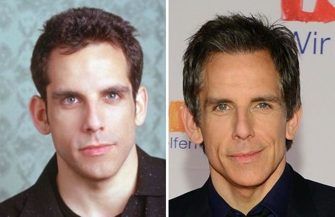 Ben Stiller Before and After Plastic Surgery: Ears, Nose, Face