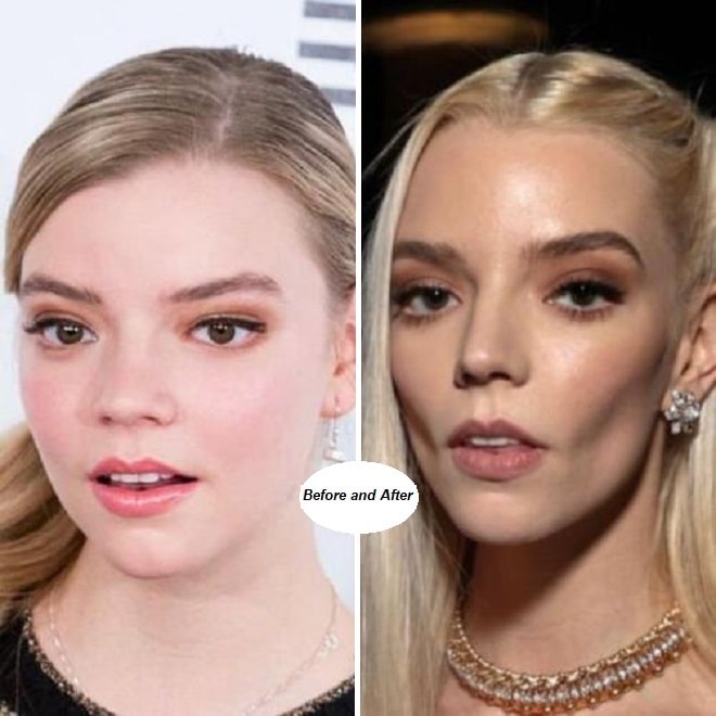 Anya Taylor Joy Before And After Anya Taylor Joy Star - vrogue.co