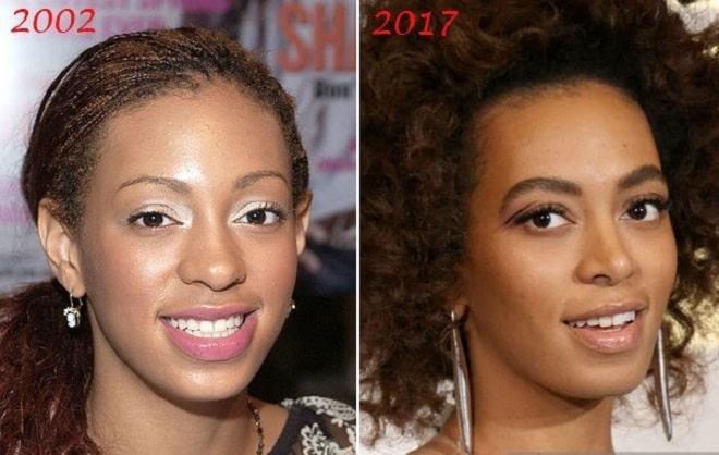 Solange Knowles Before Nose Job