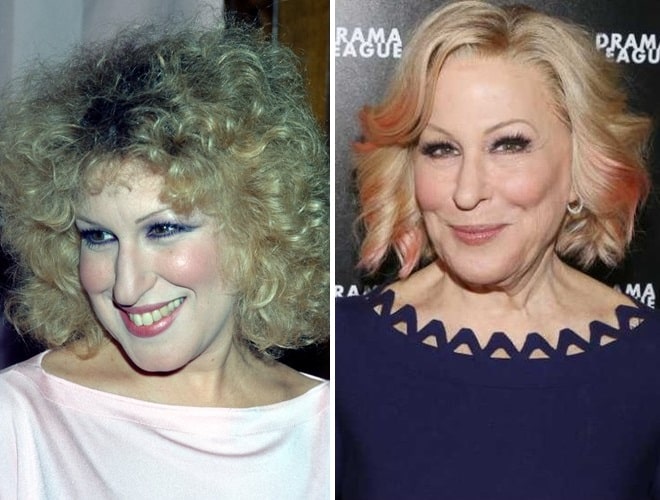 Bette Midler Before And After Plastic Surgery: Nose, Facelift, Botox