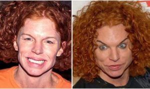Scott Thompson «Carrot Top» Before and After Plastic Surgery: Facelift